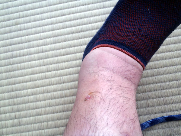 ぶよに刺されて腫れた左足首